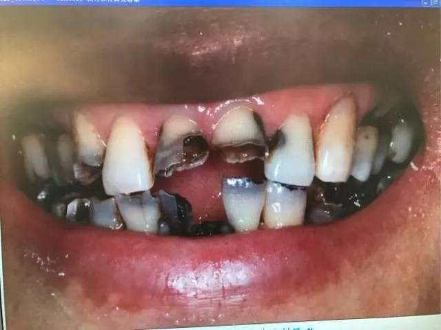 牙医遇见最烂的牙齿到底有多烂?