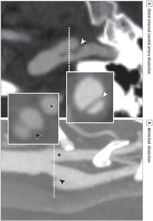 jama n:图解颈动脉蹼的影像学诊断