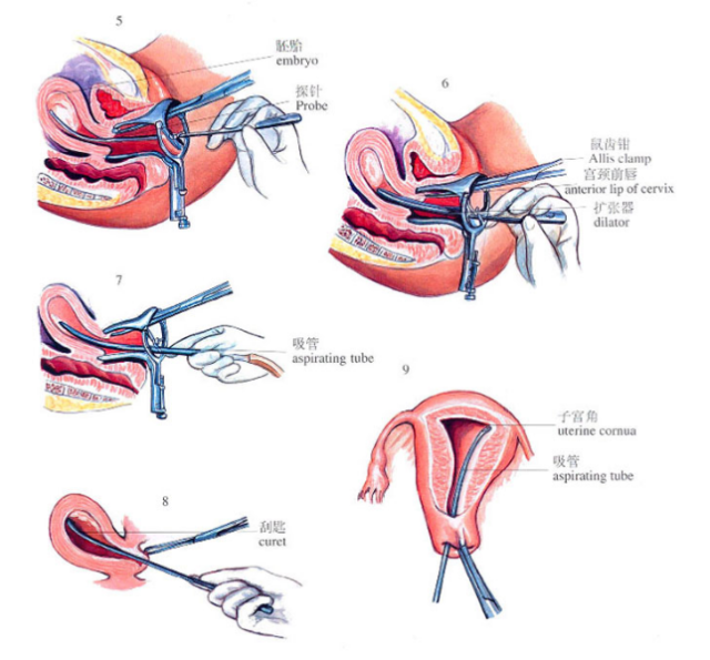 包括负压吸引术和钳刮术,负压吸引术就是用一根吸管进到宫腔,通过强大