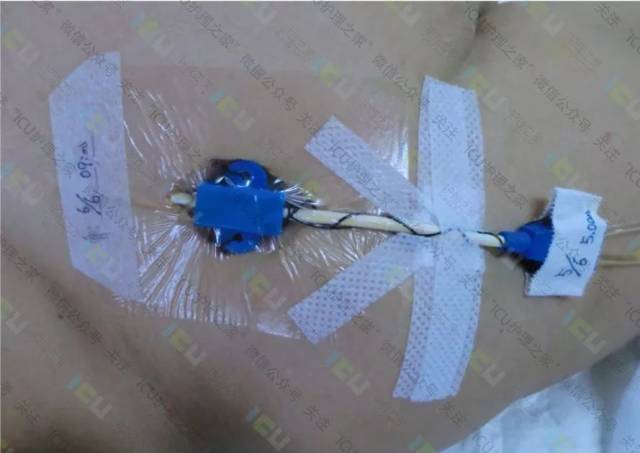 picc管,cvc,输液港使用及维护