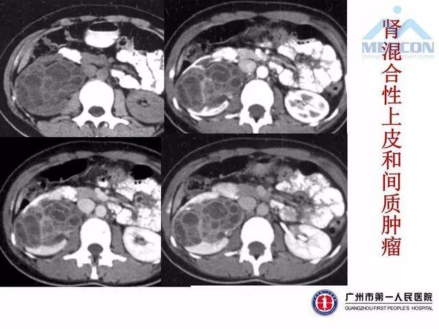 七种少见肾肿瘤ct诊断要点分析 影像天地