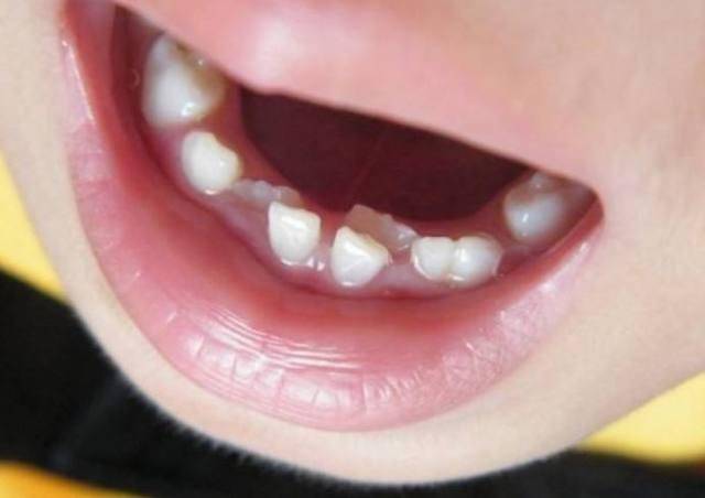 牙齿稀疏而乱的人命运如何?