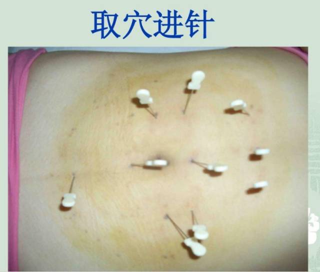 针灸针刀减肥