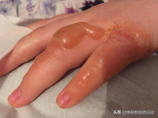 烧烫伤起水泡呢?