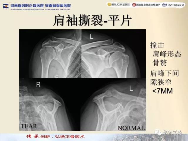 【经典】肩关节mri规范化扫描及相关病变影像学诊断