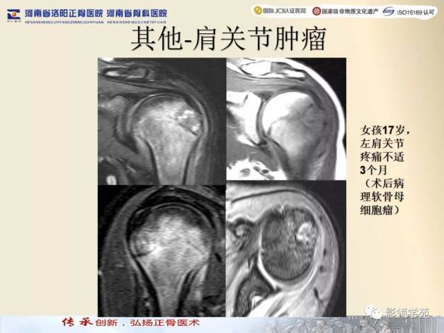 【经典】肩关节mri规范化扫描及相关病变影像学诊断