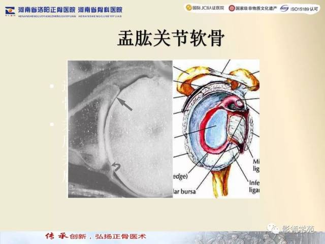 【经典】肩关节mri规范化扫描及相关病变影像学诊断