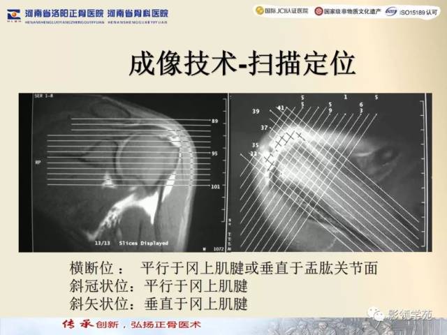 【经典】肩关节mri规范化扫描及相关病变影像学诊断