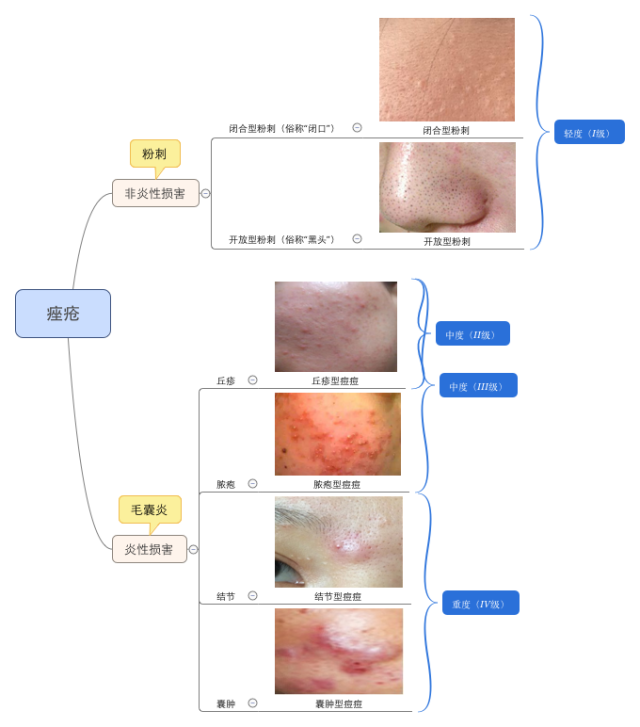 在图中我也标明了按严重程度分的四个痤疮等级