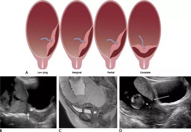b 为孕 20 周的完全性前置胎盘纵切面,箭头示胎盘完全覆盖于宫内口.