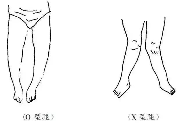 必知!"o"型腿及"x"型腿矫正方法总结