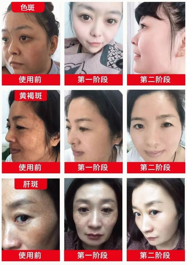 常见的 黄褐斑,雀斑,妊娠斑,蝴蝶斑,老年斑,晒斑,黑斑等都能有效祛除.