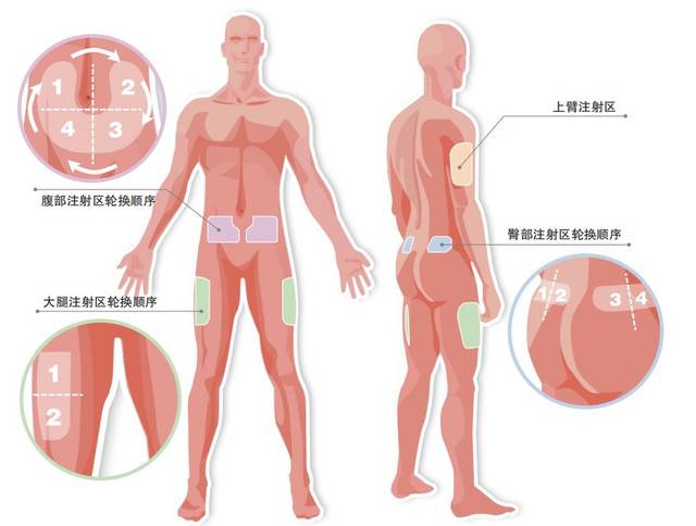 q 适合注射胰岛素的部位是? 腹部,大腿外侧,上臂外侧,臀部外上侧.