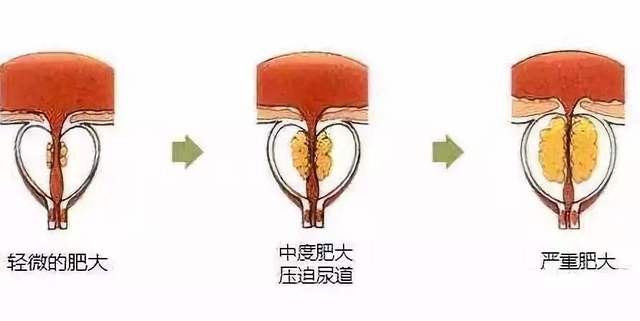 前列腺增生不能自愈,只能"治愈"!药物无效可以试试这个办法