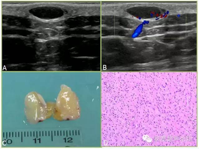 神经纤维瘤及神经鞘瘤超声诊断要点