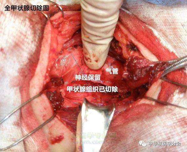 术后131碘治疗后行全身显像时发现位于甲状腺切除的部位仍有不同程度