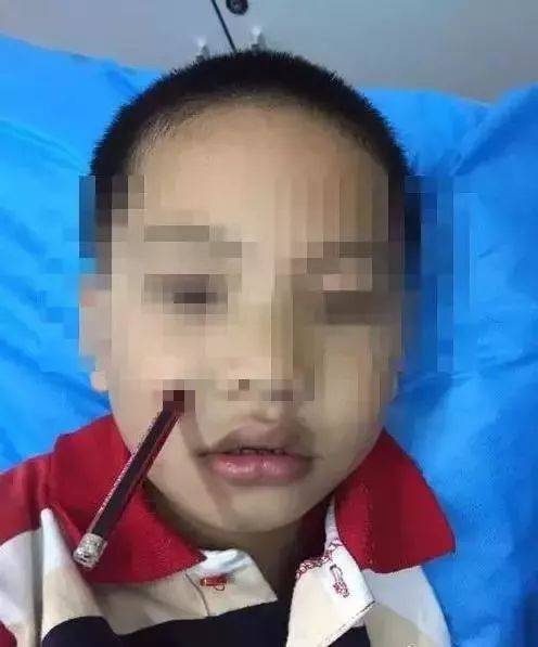 福建一名脸上插着筷子的1岁男孩入院 父母说 他们用筷子插了一截玉米
