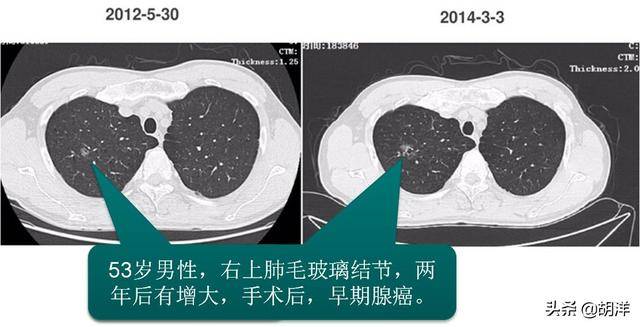 在胸部ct上的表现为均匀黑色中分布着一些树杈状或者结节状的肺纹理