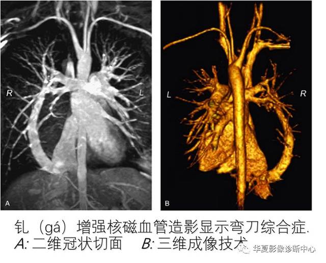 肺静脉异位引流