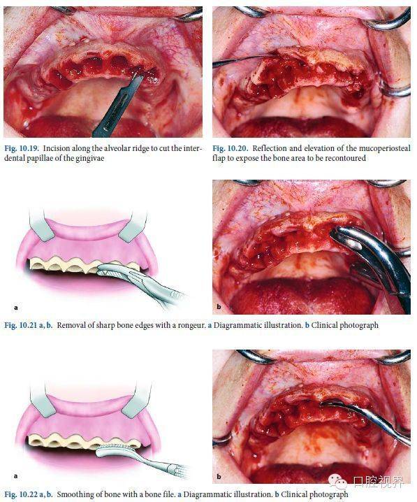 拔牙必备精美图谱微创拔牙过程详解绝对干货
