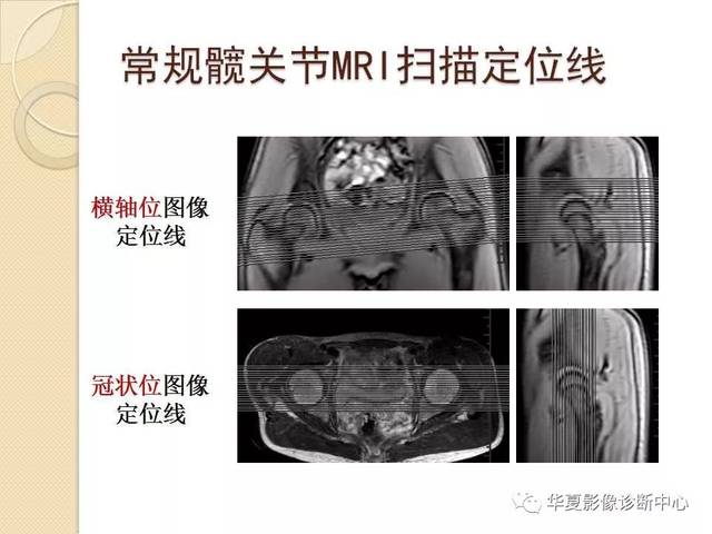 髋关节解剖及疾病的mri诊断