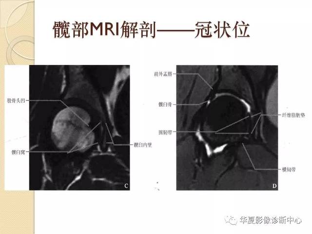 髋关节解剖及疾病的mri诊断