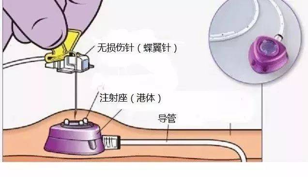 【关注】我院成功开展首例"输液港置入术"!