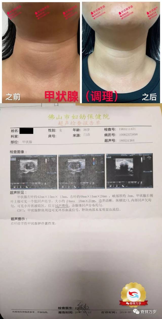 如果您的脖子粗了,很可能预示脖子里面的颈动脉血管增厚,血流变慢,易