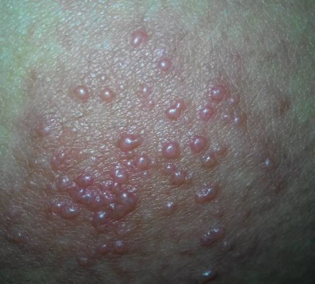 皮肤出现丘疹,红斑,小水泡,还剧烈瘙痒是怎么回事?