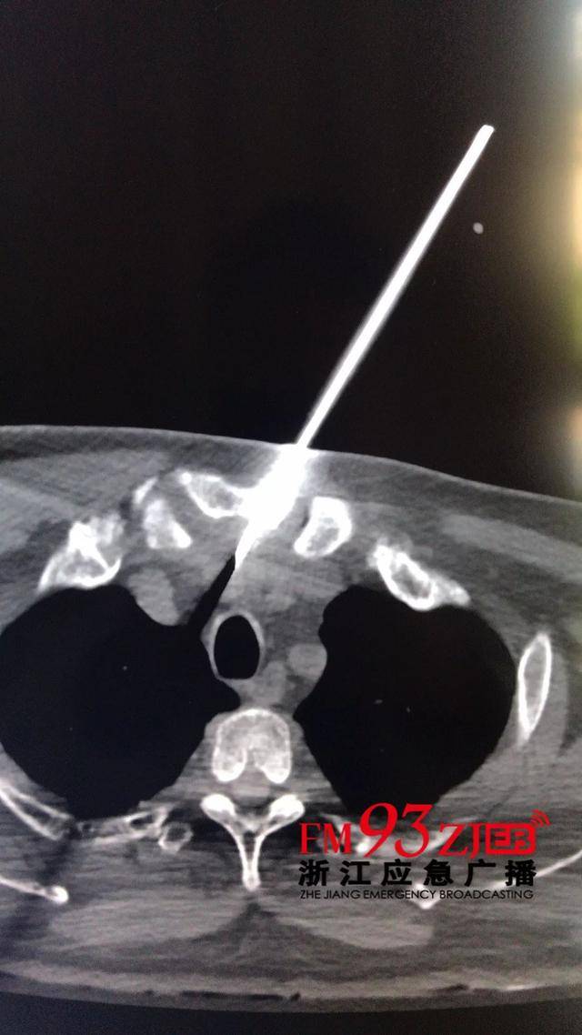 ct检测报告显示,受伤保安的前胸部受贯穿伤(利器穿胸骨柄,尖端抵达