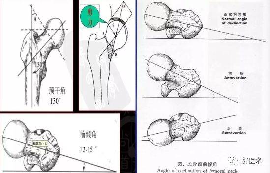 股骨颈前倾角:股骨颈前倾角是指股骨颈的中轴线与股骨内外髁中点间的