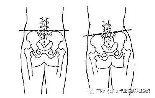 导致骨盆左右倾斜