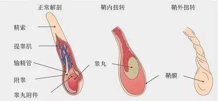 疼痛,坐立不安,同时还会伴有下腹部疼痛不适,恶心,呕吐,发热,阴囊红肿