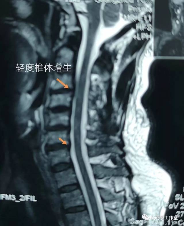 谈骨论筋 | 颈椎引起的头晕怎么办?专家给您些小妙招来解决!