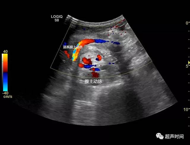 视频 3 cdfi 可见肠系膜上动脉螺旋状走行 基于临床症状体征和超声