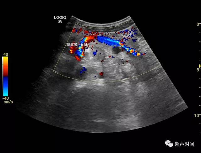 视频 3 cdfi 可见肠系膜上动脉螺旋状走行 基于临床症状体征和超声
