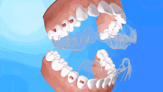 8个真实案例 | 牙齿矫正,拯救你的"没下巴"!