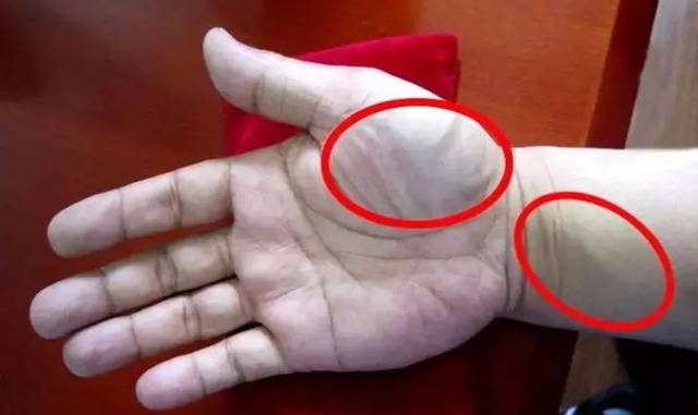 3 手掌变胖大鱼际青筋 或提示痰瘀结合 这种变化不仅仅代表有瘀的问题