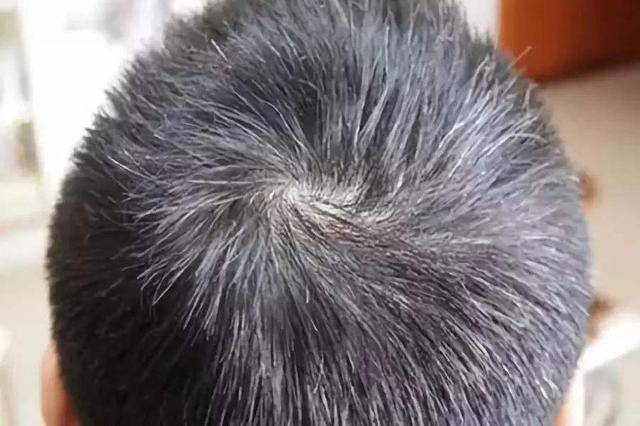 前额白发 — 脾胃不好