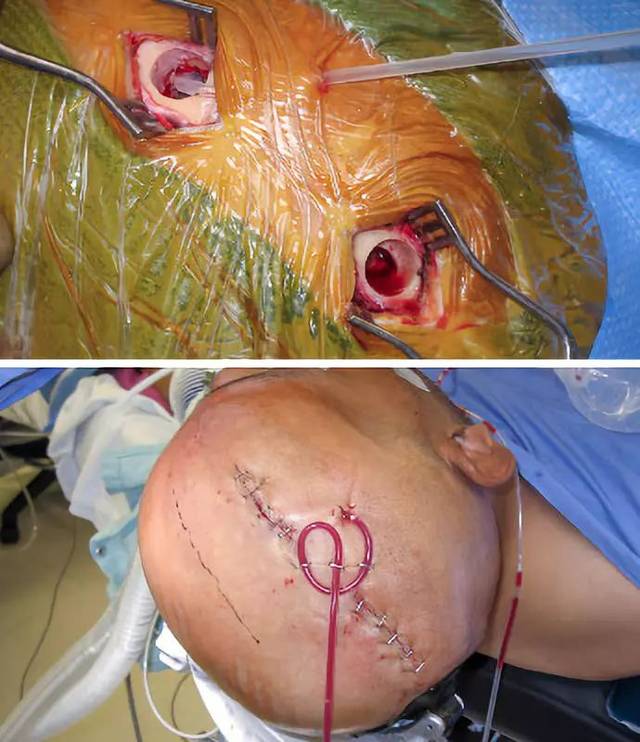 慢性/亚急性硬膜下血肿的手术策略与技巧 | the neurosurgical atlas