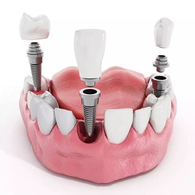 提高种植牙成功率的4个关键因素
