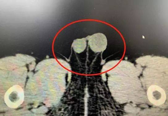 3岁男童"蛋蛋"增大,竟是睾丸肿瘤 孩子私处您更要留心