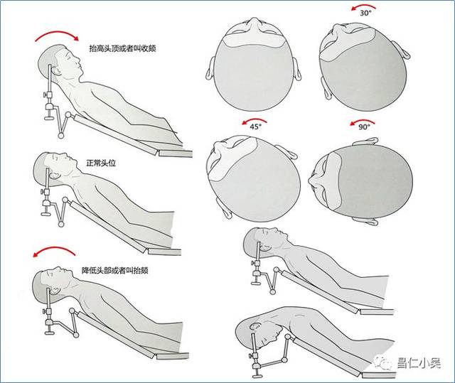 神经解剖学习笔记: 神外手术的体位