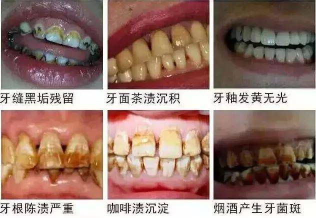 黄牙,黑牙,氟斑牙,四环素牙,三小时帮你解决——齿加颜