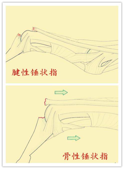 手指突然像"锤子"一样,怎么回事?