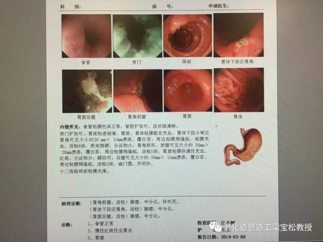 必须活检的胃溃疡