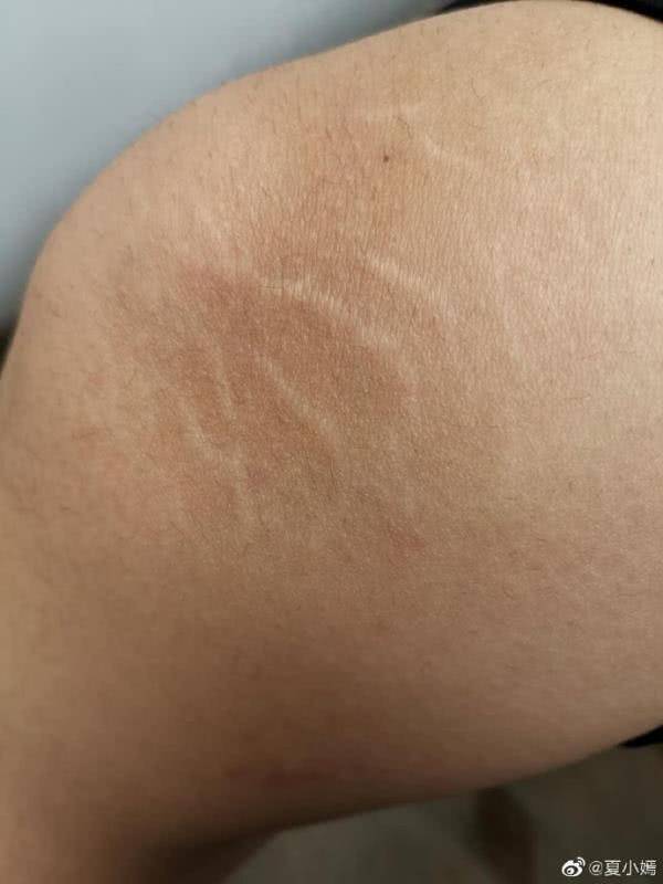 怎样才能让膨胀纹别再"膨胀"?只能改善,要彻底治疗仍是难题