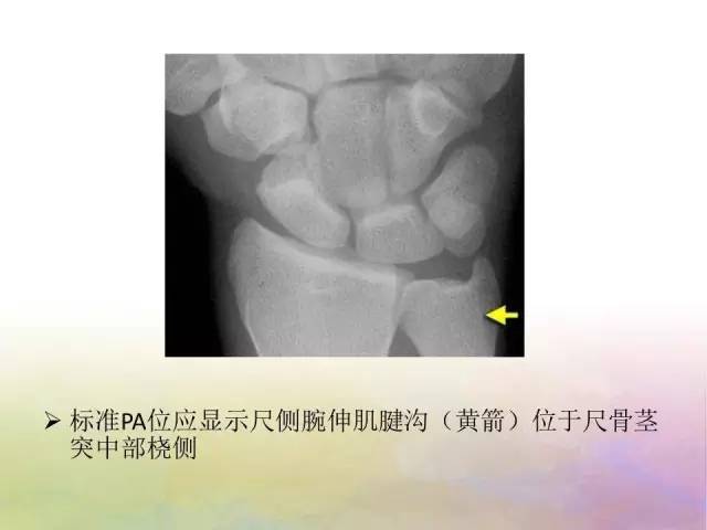 腕关节解剖详解