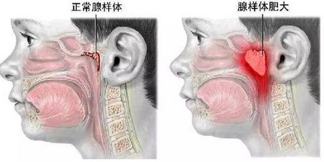 用嘴呼吸能改变脸型?错误方式堪比"毁容"!先闭嘴看完.