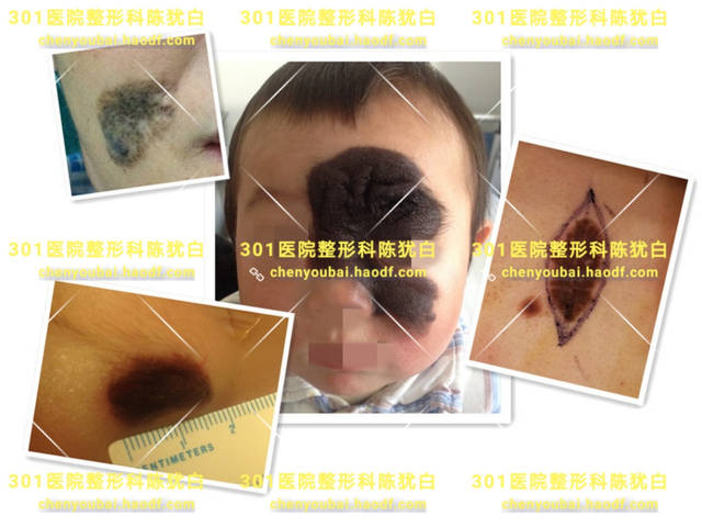 黑痣的常见问题.是否会恶变?是否需切除?术后有疤吗?